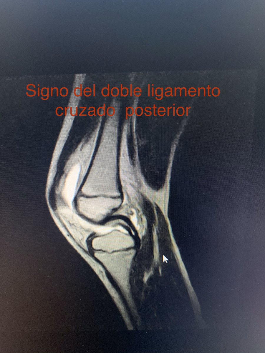 Ligamento Cruzado Anterior (LCA) – rodilla.co, image size:900x1200