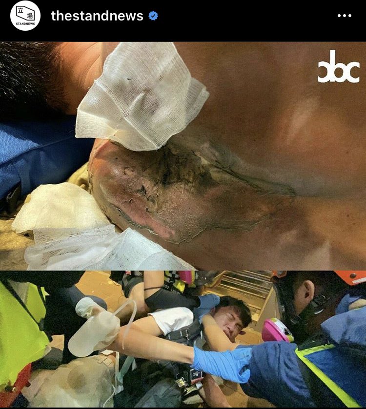 qzpmgggggg's tweet photo. A press got shot by tear gas today
No protesters around at that time
Photo from City Broadcasting Channel(CBC)
#november2nd
#StandwithHonKong #FightForFreedom https://t.co/pgn4xvmEFR