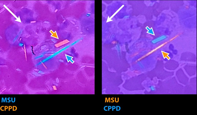 gout vs pseudogout crystals