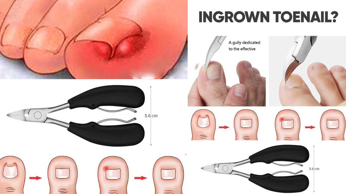 Cancelo Ingrown No Twitter