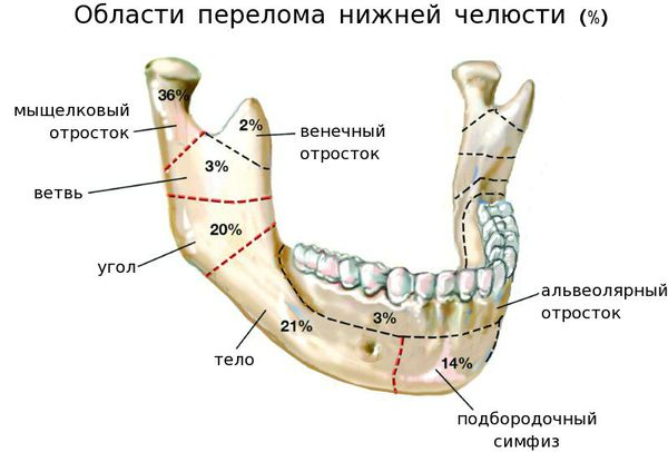 Травматический латынь. Перелом челюсти в области мыщелкового отростка. Венечный отросток нижней челюсти. Перелом нижней челюсти в области суставного отростка. Мыщелковый отросток нижней челюсти.