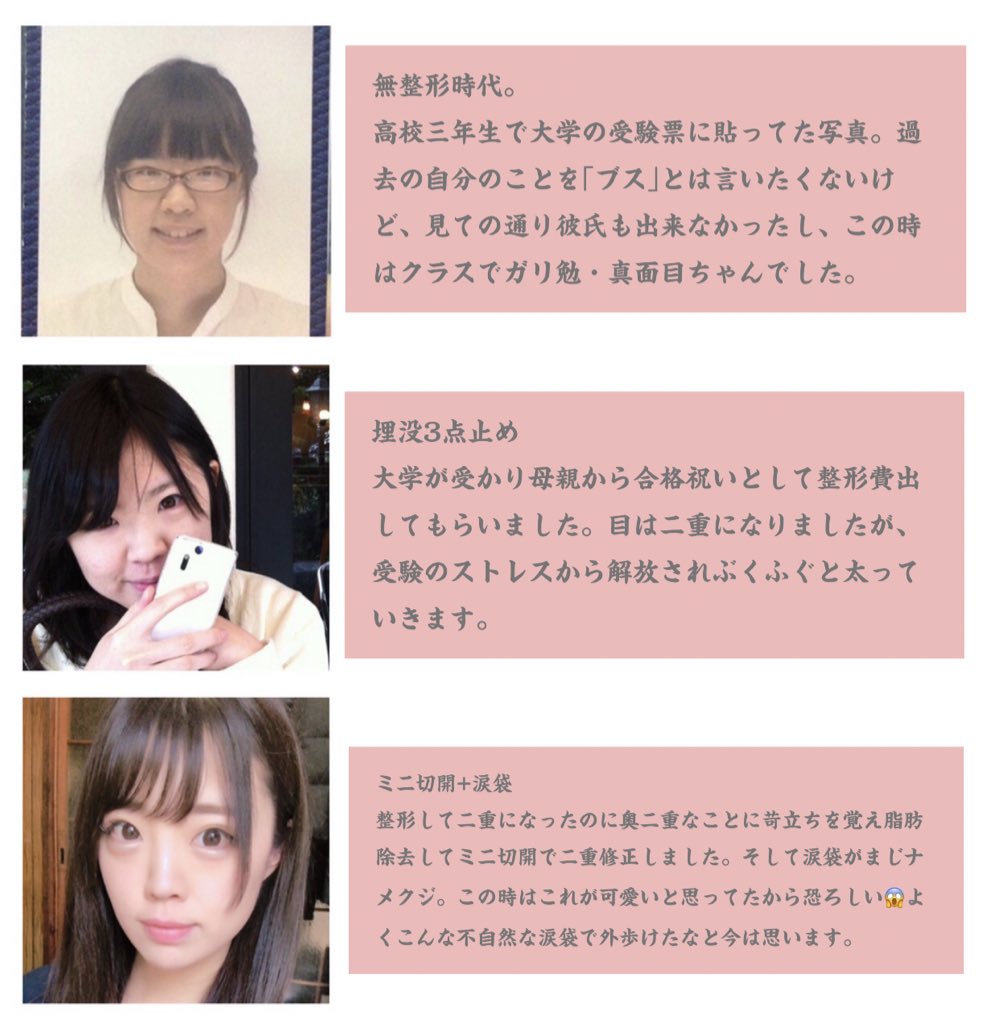 terrorist_chan's tweet photo. 私の整形過程
大手整形垢に比べようがないくらい経験値は低いですが少しでも参考になればと思い載せました。因みに「失敗したな」と思う施術は涙袋くらいです。参考までに、埋没→○の森 ミニ切開→○川 涙袋→東○美容外科 ミスコ+ヒアル→キップ○ https://t.co/QKfAo4EOA4