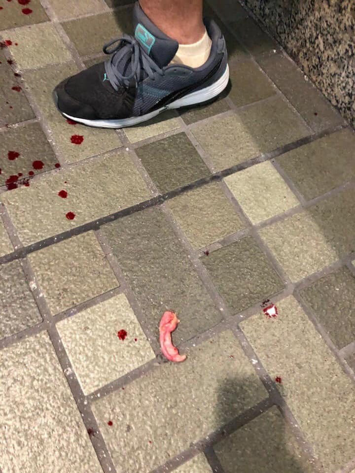 hoccgoomusic's tweet photo. *🚫Graphic content alert🚫*

District counselor Andrew Chiu’s ear was bit off by a pro-Beijing supporter.  The man charged onto citizens and attacked the crowds with a knife, resulting in 6 injured. Chiu came to help, was assaulted by man, who bit half his ear off.

#HKprotests https://t.co/leSCEhyiYu