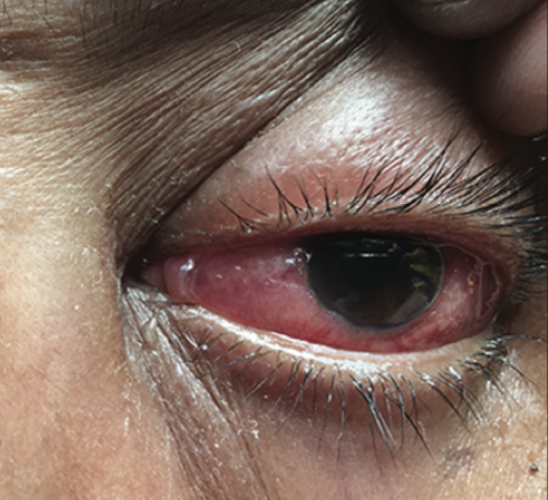IJRheum's tweet image. #Eyelid #Edema in #Relapsing #Polychondritis
ow.ly/cYIR50wXeDE

#Vasculitis @VasculitisFound @VasculitisIA @anzvasc  #rheum #rheumatology #indianrheum