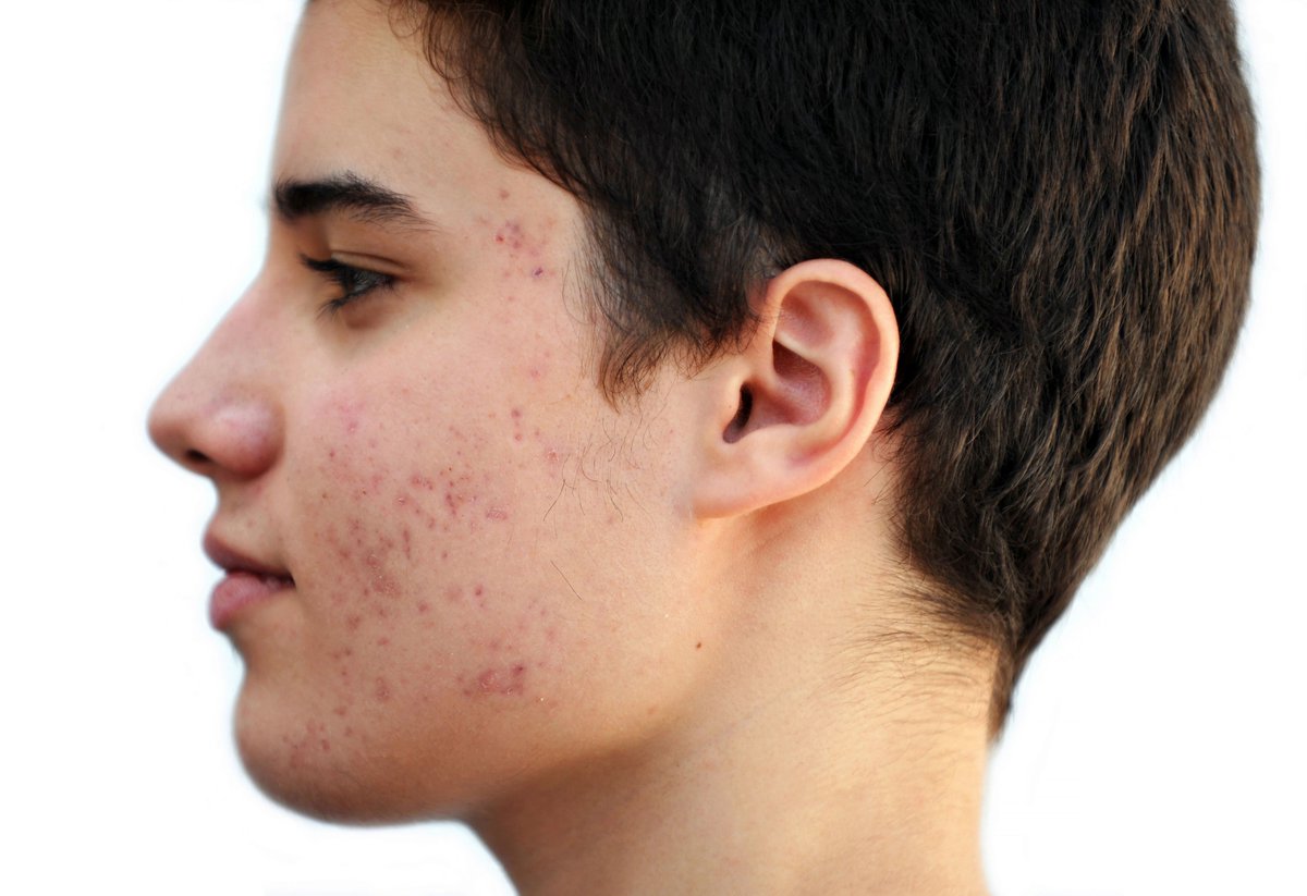 Recent findings: #acne patients may underestimate the role of topical treat...