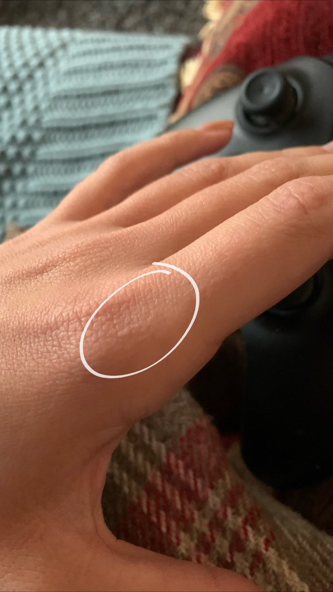 Jess Mcfadyen En Twitter I Have A Scar On My Knuckle From