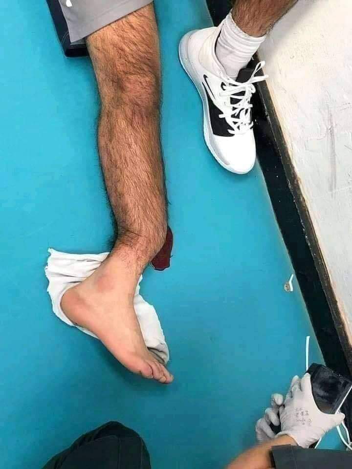 صورة تبين إصابة قوميز 
😳🦴🦶🏼