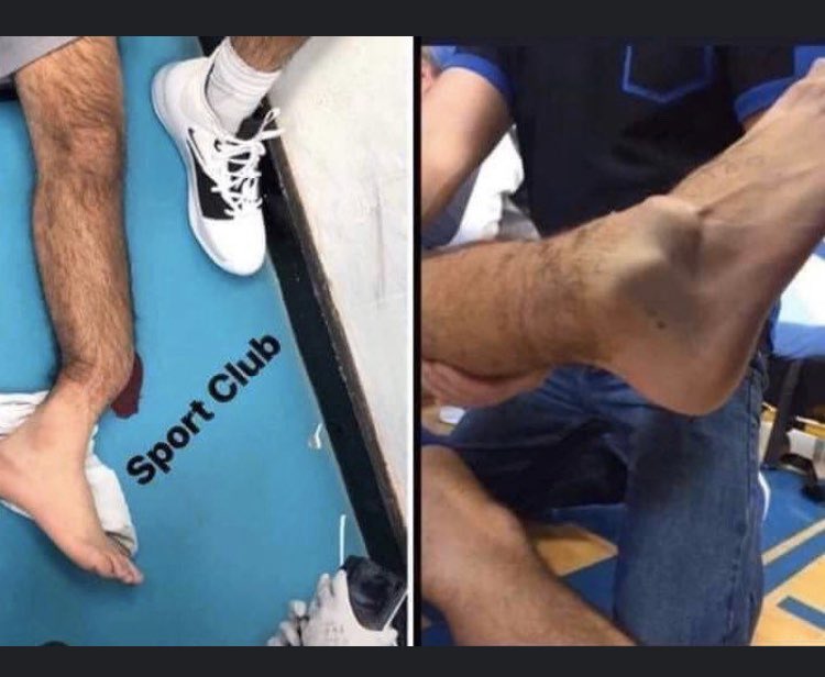 Mode55489648's tweet photo. Les images terribles de la jambe d’André Gomez #EVETOT https://t.co/Sepfycpqsd