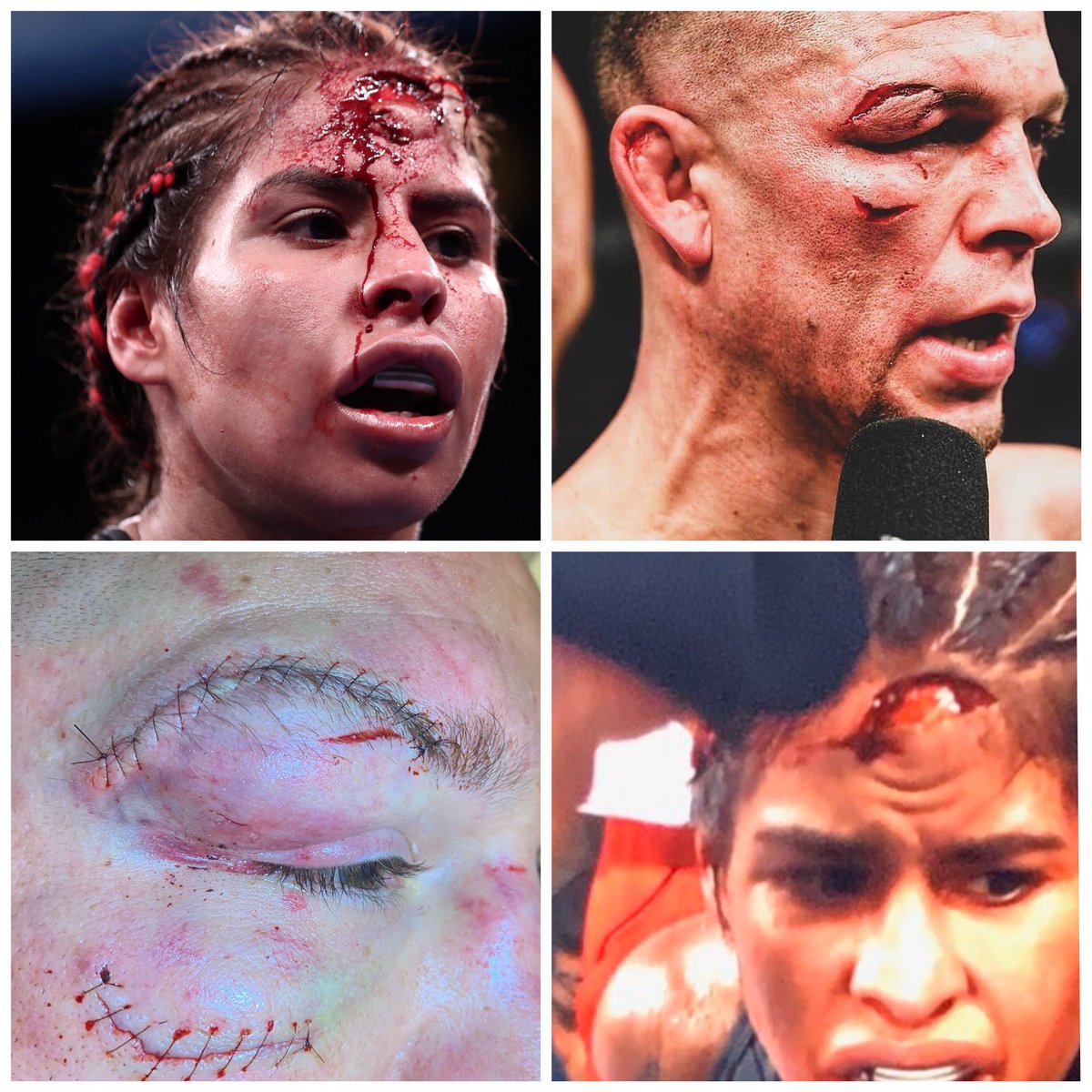 Nate Diaz wasn't the only person to get a fight stopped by cut this weekend. On the undercard of Canelo vs Kovalev Marlen Esparza lost by TD after a crazy cut from a headbutt.
Which was worse?
#UFC244 #CaneloKovalev
