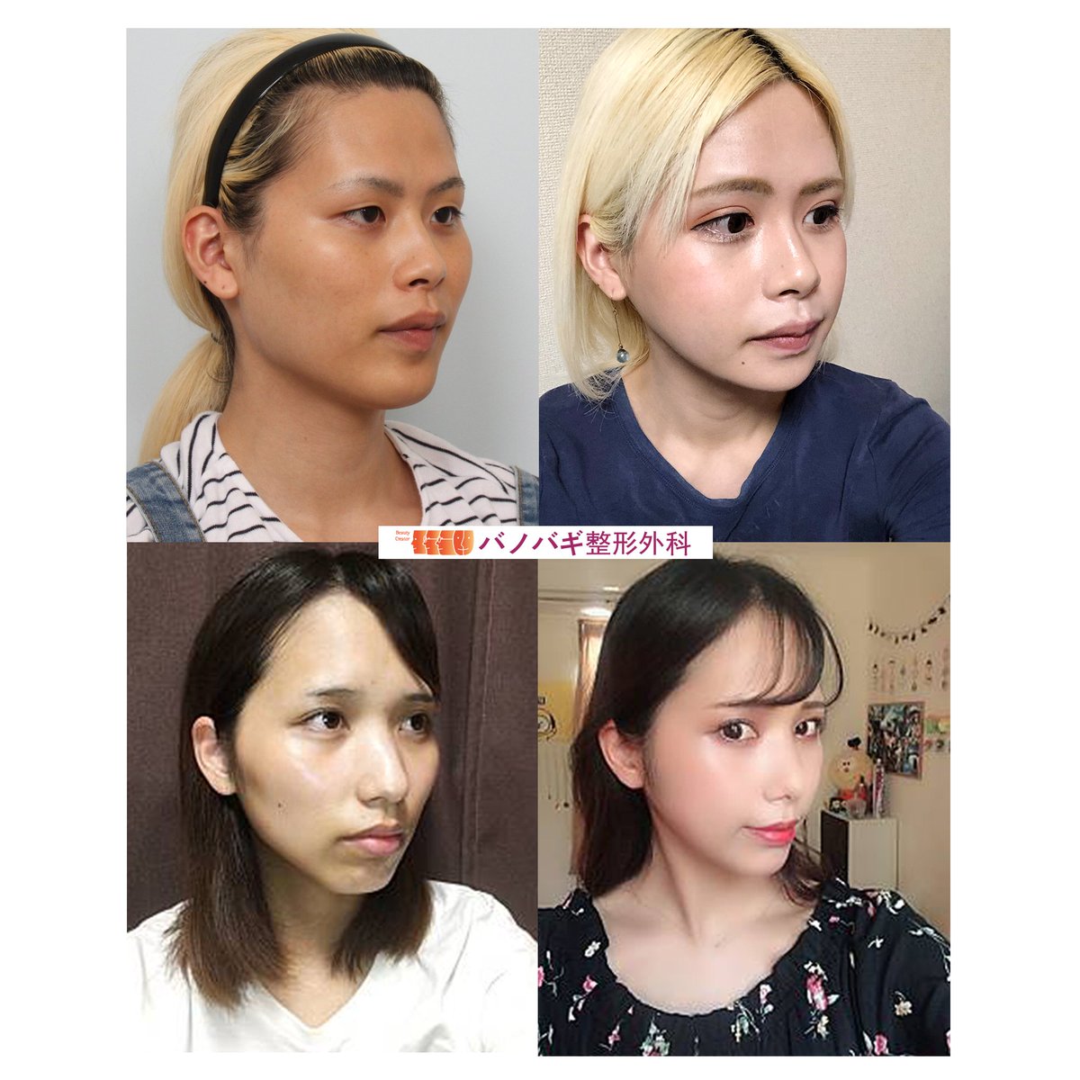 バノバギ整形外科 手術センター Pa Twitter 人生を変えたい貴方 年 Bs全国放送予定の番組を バノバギ がサポートします 詳細な内容はこちらから T Co Dennfytecz 韓国美容外科 韓国整形 顔面輪郭 小顔整形 輪郭手術 輪郭 全身整形 バノバギ整形外科 手術センター Pa Twitter 人生を変えたい貴方 年 Bs全国放送予定の番組を バノバギ がサポートします 詳細な内容はこちらから T Co Dennfytecz 韓国美容外科 韓国整形 顔面輪郭 小顔整形 輪郭手術 輪郭 全身整形