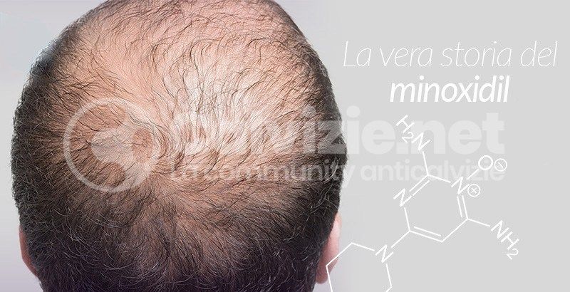Cura calvizie 2020 Cura calvizie 2020