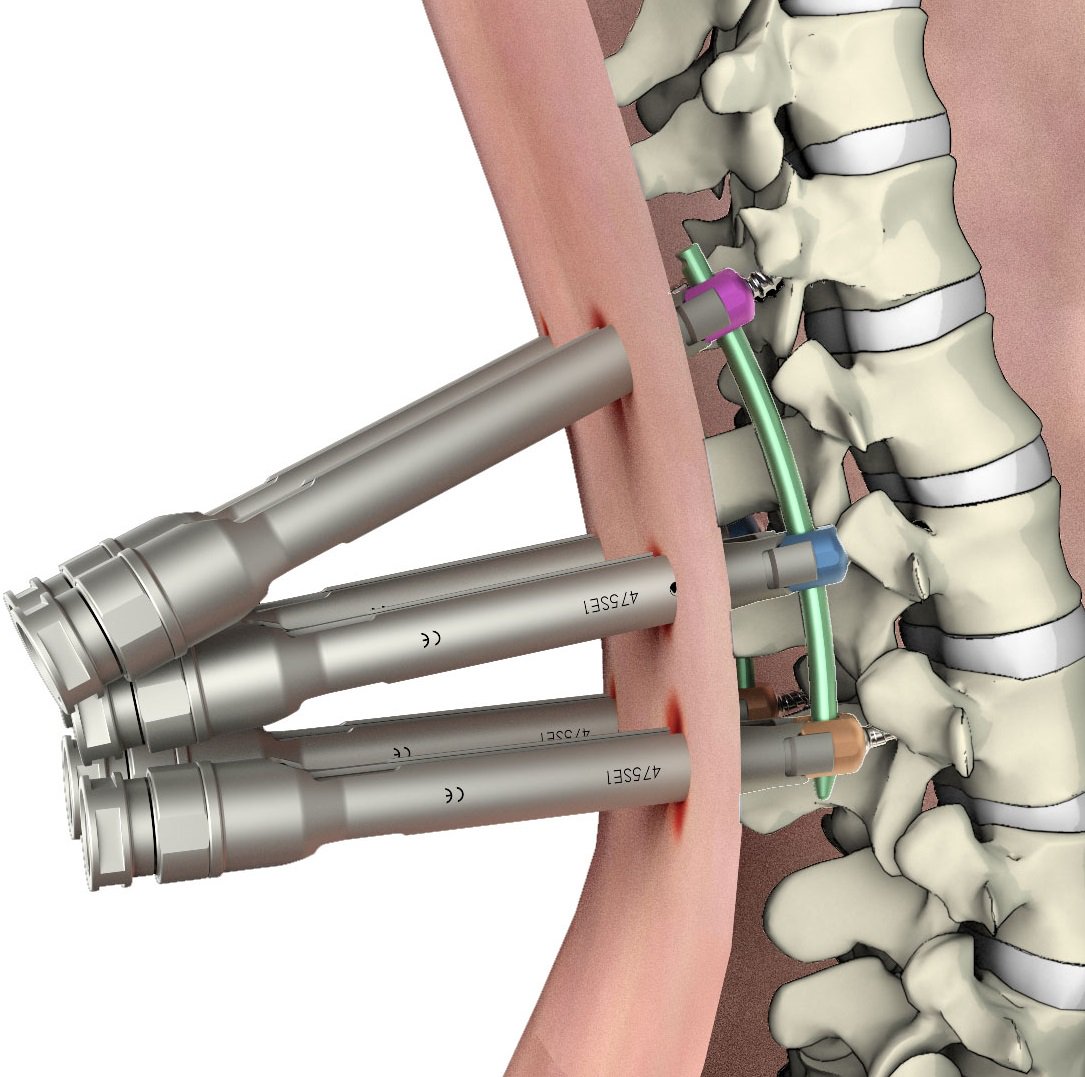 Spineway1's tweet photo. #Spineway vient de se voir délivrer un nouveau #brevet en Europe pour sa gamme innovante de #chirurgie mini-invasive : Mont-Blanc MIS.
➡ https://t.co/txxAIH9P19.
#health #santé #miniinvasive #rachis #spine #colonnevertébrale https://t.co/tTciUQShW1