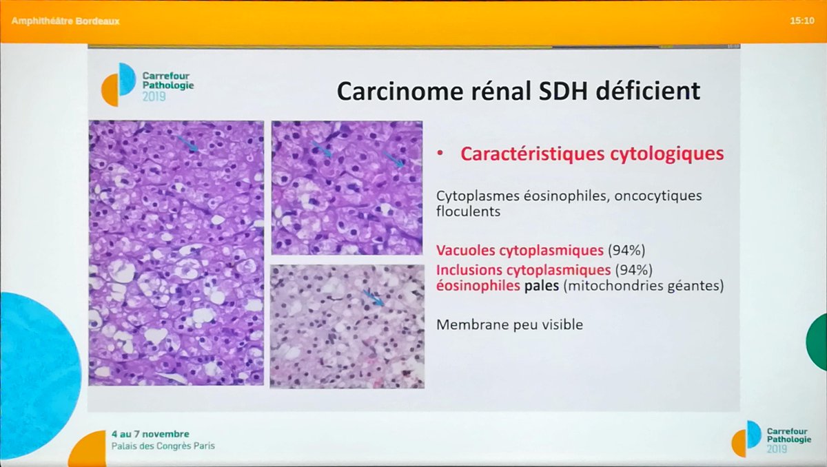 Annpathol's tweet image. SDH deficient renal cell carcinoma