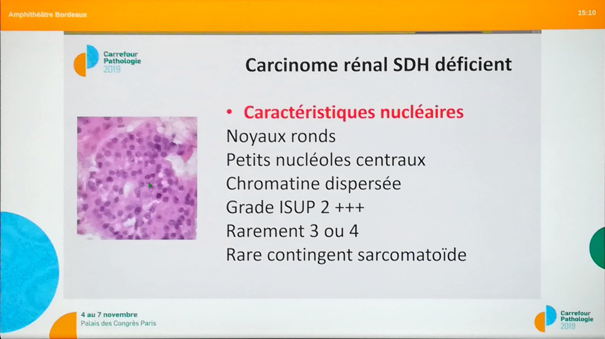 Annpathol's tweet image. SDH deficient renal cell carcinoma