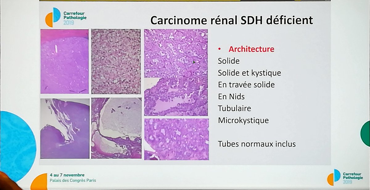 Annpathol's tweet image. SDH deficient renal cell carcinoma