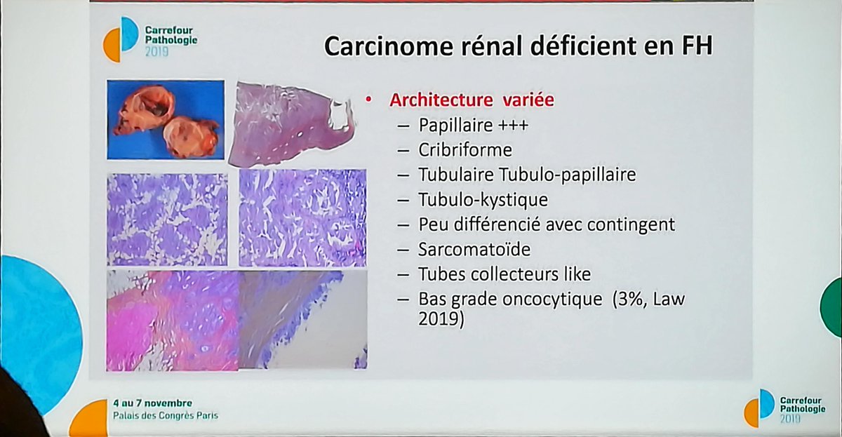 Annpathol's tweet image. FH deficient renal cell carcinoma