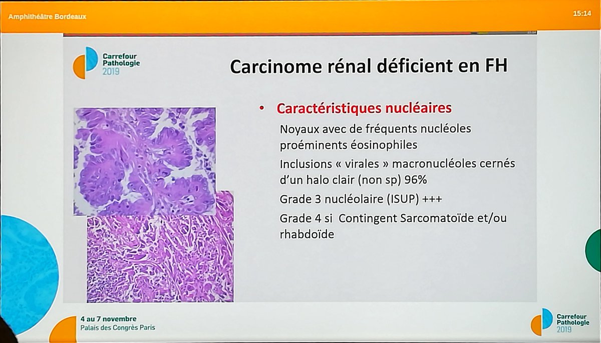 Annpathol's tweet image. FH deficient renal cell carcinoma