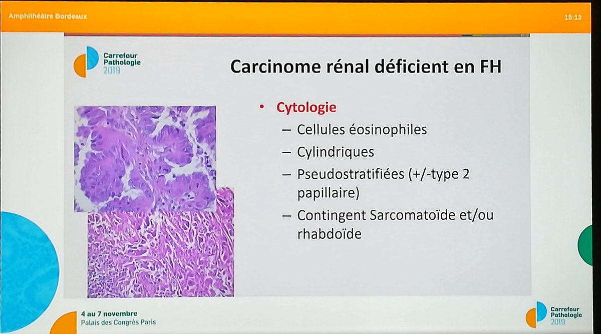 Annpathol's tweet image. FH deficient renal cell carcinoma