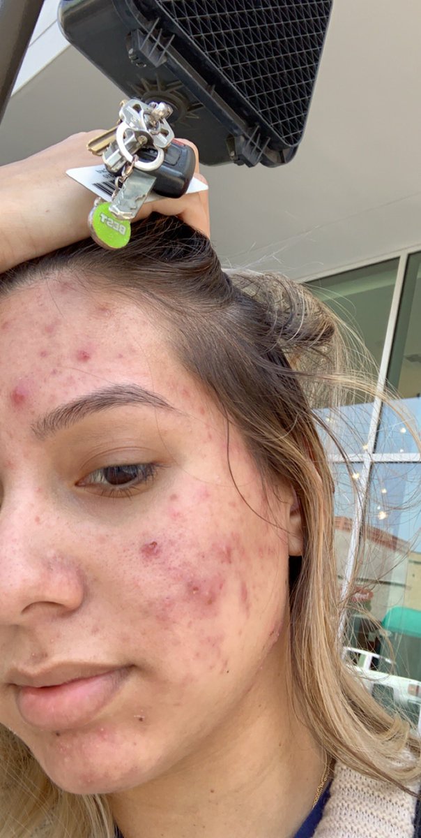 lopezgiselle55's tweet image. 5 months ago I i struggled with cystic acne , I was in so much pain I couldn’t touch my face ! I couldn’t even put make up on . I would cry everyday of how ugly I felt but thank you Accutane for this amazing journey I can finally say I’m a new me .