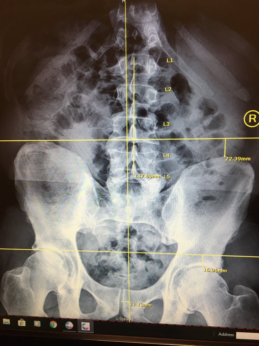 MasterControls's tweet image. Tight Psoas Muscle- The best place to release a tight Psoas is by finding the ASIS (the lump at the front of the ilium) and going down one inch, then medial one inch. You should be on the Pubic bone now and rub up into the abdomen where it is sore for only 30 seconds. It works.