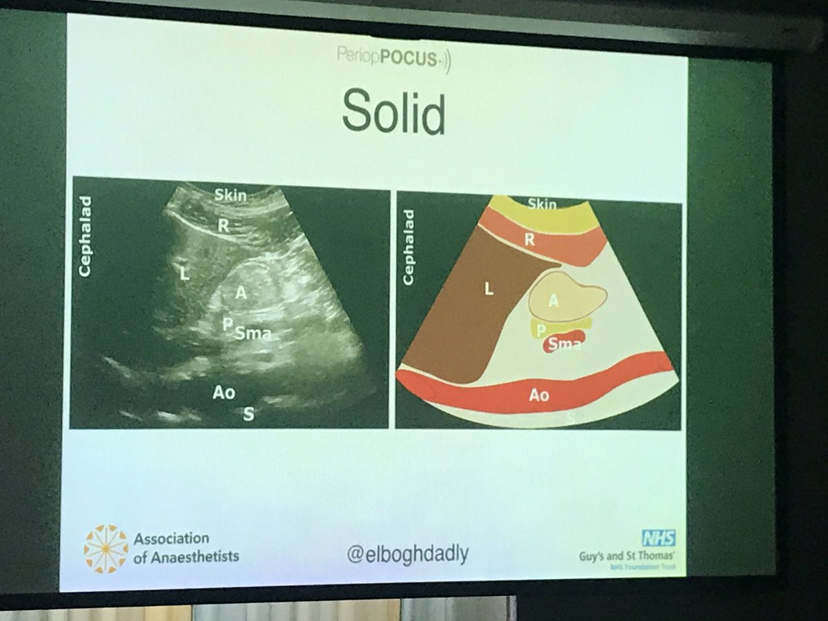 @elboghdadly talking about gastric ultrasound #PeriopPOCUS Is it Empty? Did my patient really not eat or drink? #Ultrasound guides you to help find out more #POCUS