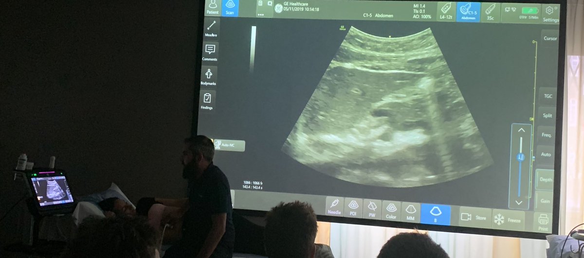 Dynamic gastric antrum scanning at Periop PoCUS, London today with ⁦@elboghdadly⁩ #ultrascoundrels Thanks ⁦@rosie_hogg⁩