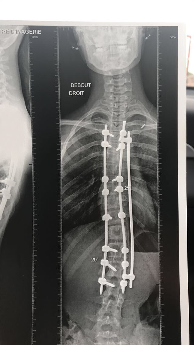 daphsermet's tweet photo. #jaiuneparticularitéphysique
Scoliotique ma fois🔩 https://t.co/GAJL9KNSRG
