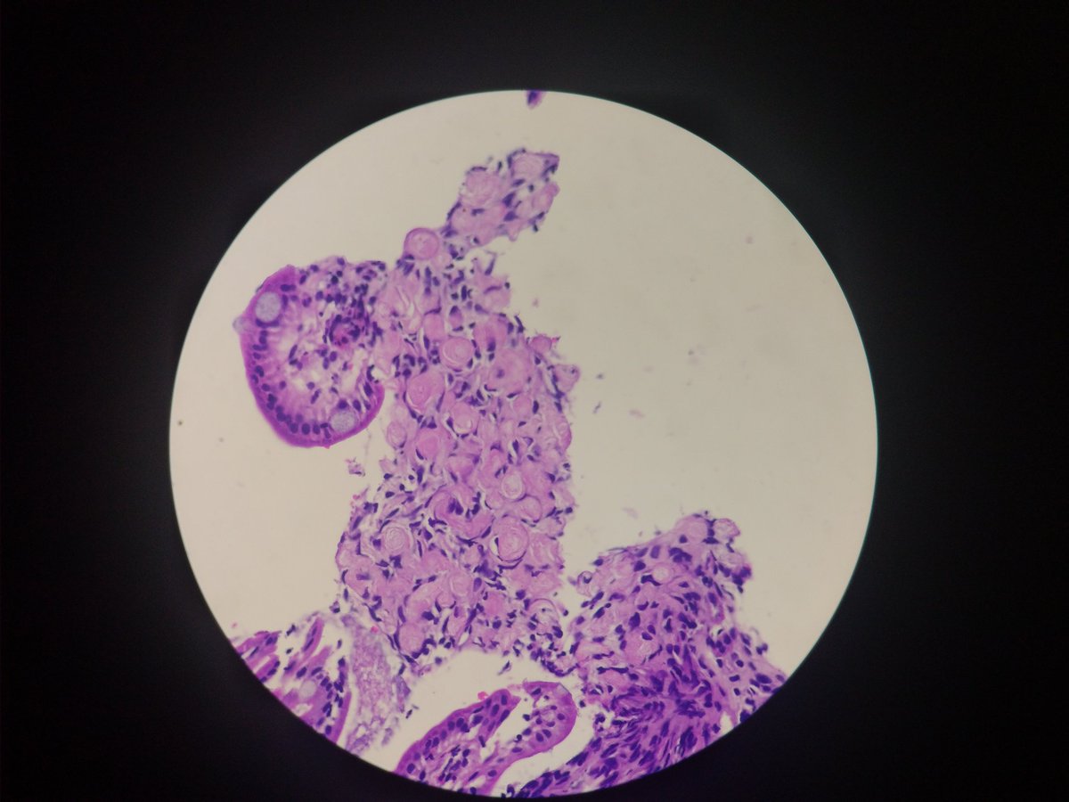 vi_monappa's tweet photo. Hi dear #tweeples... Had been away for a while. Happy to be back. #GIpath #PATHOLOGY #GIPATH Ileal bx . Special stains are Congo red and PAS. @DraEosina @ariella8 https://t.co/0lwRZVV1BX