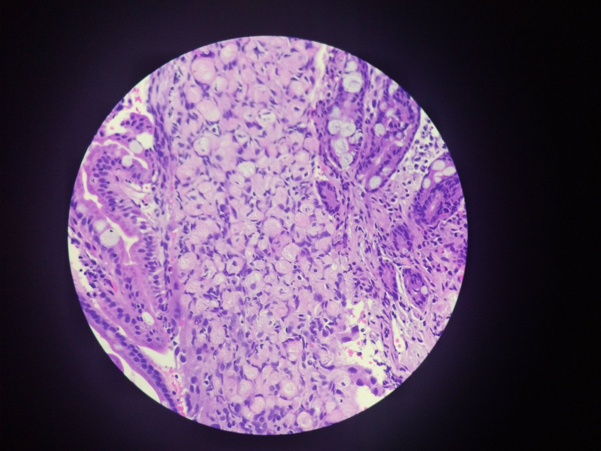 vi_monappa's tweet photo. Hi dear #tweeples... Had been away for a while. Happy to be back. #GIpath #PATHOLOGY #GIPATH Ileal bx . Special stains are Congo red and PAS. @DraEosina @ariella8 https://t.co/0lwRZVV1BX