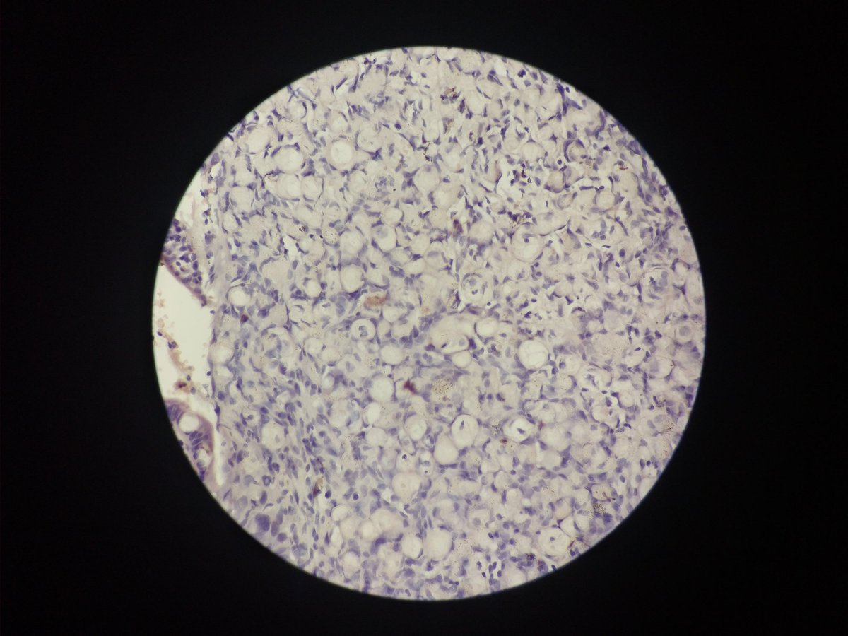 vi_monappa's tweet photo. Hi dear #tweeples... Had been away for a while. Happy to be back. #GIpath #PATHOLOGY #GIPATH Ileal bx . Special stains are Congo red and PAS. @DraEosina @ariella8 https://t.co/0lwRZVV1BX