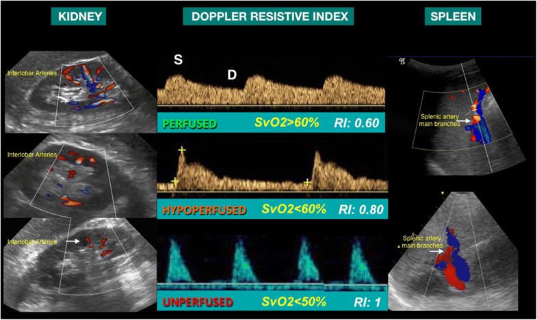 Asesoramiento guiado por Ecografia de la perfusión de los órganos en el paciente crítico: ampliando la monitorización a la hipoperfusión en el shock. #PedsICU #FOAMED <a href="/SECIP_Us/">GT Ecografia SECIP</a> 

Acceso libre en <a href="/yourICM/">Intensive Care Medicine</a>  

Artículo: bit.ly/2JT6sXs