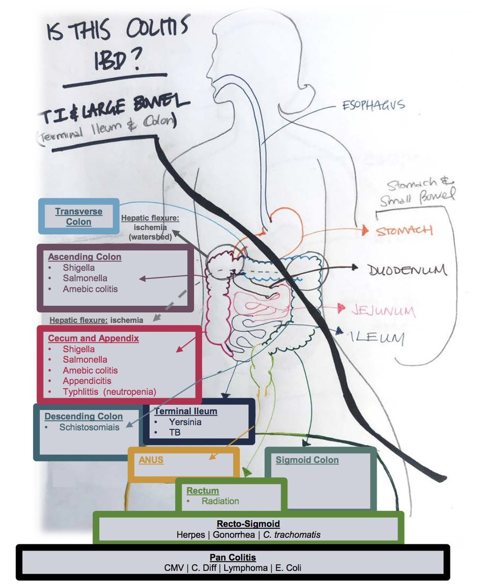 A young man comes in with colitis on imaging; is this IBD? If not, how do I even go about thinking about what else it could be? 
One approach: location, location, location! See below for a segmental road map of colitis below. #knowledenugget #medtwitter
ucsfmed.wordpress.com/2019/11/04/mof…