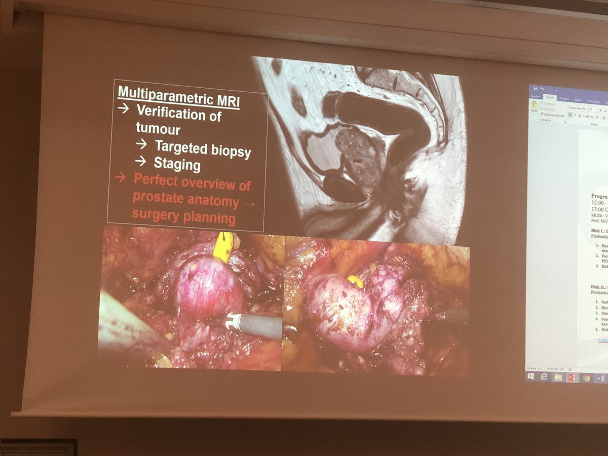 Peter_Beniac's tweet photo. @milanhoraplzen profesor Hora prednasi na V. Plzenskem dni karcinomu prostaty na tema radikalni prostatektomie. Radical prostatectomy - a presentation by Prof. Hora at the 5th Pilsen Prostate Cancer Day #uroczech @Urology_Plzen #UroSoMe https://t.co/DbNowjTDB3