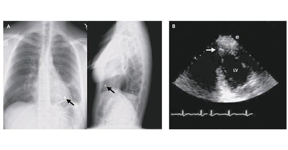 NEJM's tweet photo. From the #NEJMArchive: Shot to the Heart https://t.co/3VUrawVc7E https://t.co/3ylkiM4ZU7