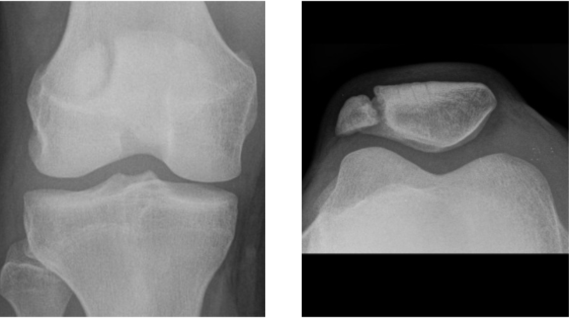 How common is bipartite patella?

A #BipartitePatella is found as an incidental finding on about 2% of knee x-rays, which would mean that it is present in about 1 in 50 patients. Click here for more information: medilink.us/pk6x/#5