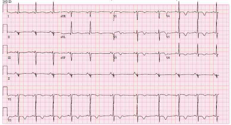 MayoClinicCV's tweet photo. #TeachingCaseTuesday 🤓🥼

📟You’re called to the ED at 3AM for a middle-aged man with 5 hours of chest pain. Hs-troponin is 184. PMedHx is significant for rheumatoid arthritis. Vitals and cardiac exam are normal. Initial ECG is below. 

What is your management strategy? https://t.co/8m8JYtRx71