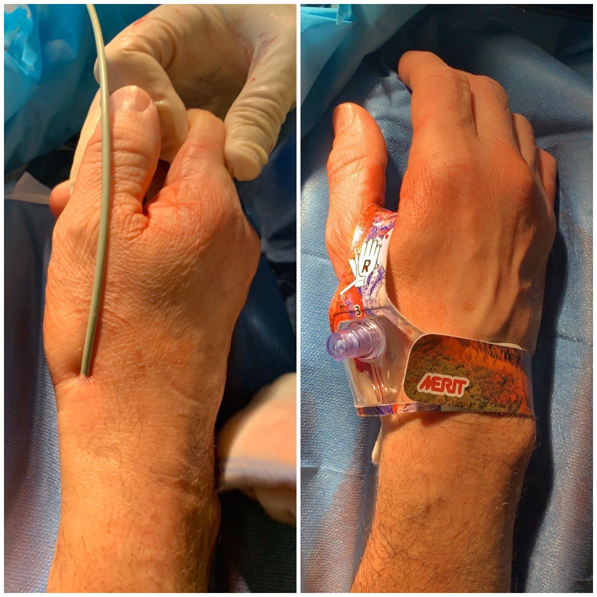 As @AjitSPuri1 says: “Distal radial approach rocks! “ Here the Ballast 088 long sheath today. It is impressive to cure complex Neurovascular pathology through such a distal small artery #RadialFirst #neurointervention