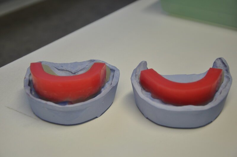 Пробы гербста на верхней и нижней челюсти. Границы базиса съемного пластиночного протеза на нижнюю челюсть. Функциональные пробы по гербсту для нижней челюсти. Отливка гипсовых моделей беззубых челюстей. Прикусной валик на верхней челюсти.