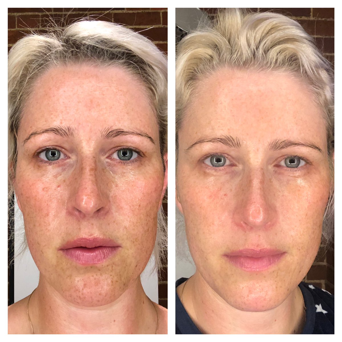@TropicSkincare Amazing results after 1 month of using smoothing cleanser, toner, skin feast in am and skin dream pm, and super greens. Face mask twice a week too. Brighter, less congested, and love having a morning and evening ritual to focus on self care #selfcare #betterskin