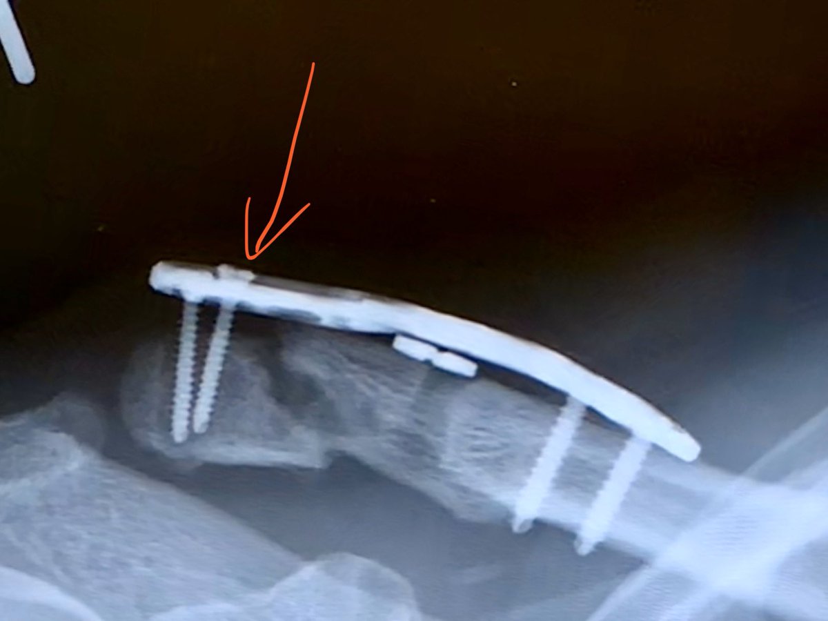 骨移植 最近の進歩