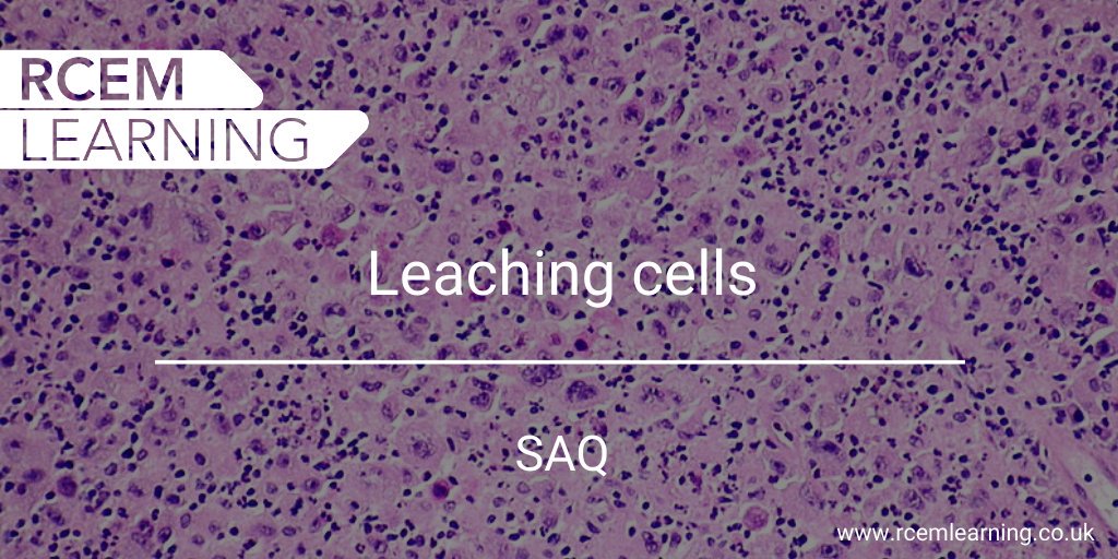 A 62-year-old female with lymphoma who had her last chemotherapy 4 days ago presented to the ED with palpitations, weakness and generalised lethargy. She was apyrexial.

We have a new SAQ for you here 👉 bit.ly/34zcqVi