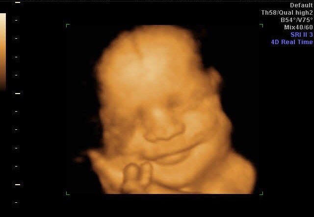 IVFMDFlorida's tweet photo. Meet the Wimberly Baby! 31 weeks with a full head of hair, long eyelashes and already a very full face with a smile! 😊 Best of all, baby is healthy and treating mommy great! Thank you to our patient for checking in with us and allowing us to share this joy!
#IVFMD #infertility https://t.co/2WvIEInNNK
