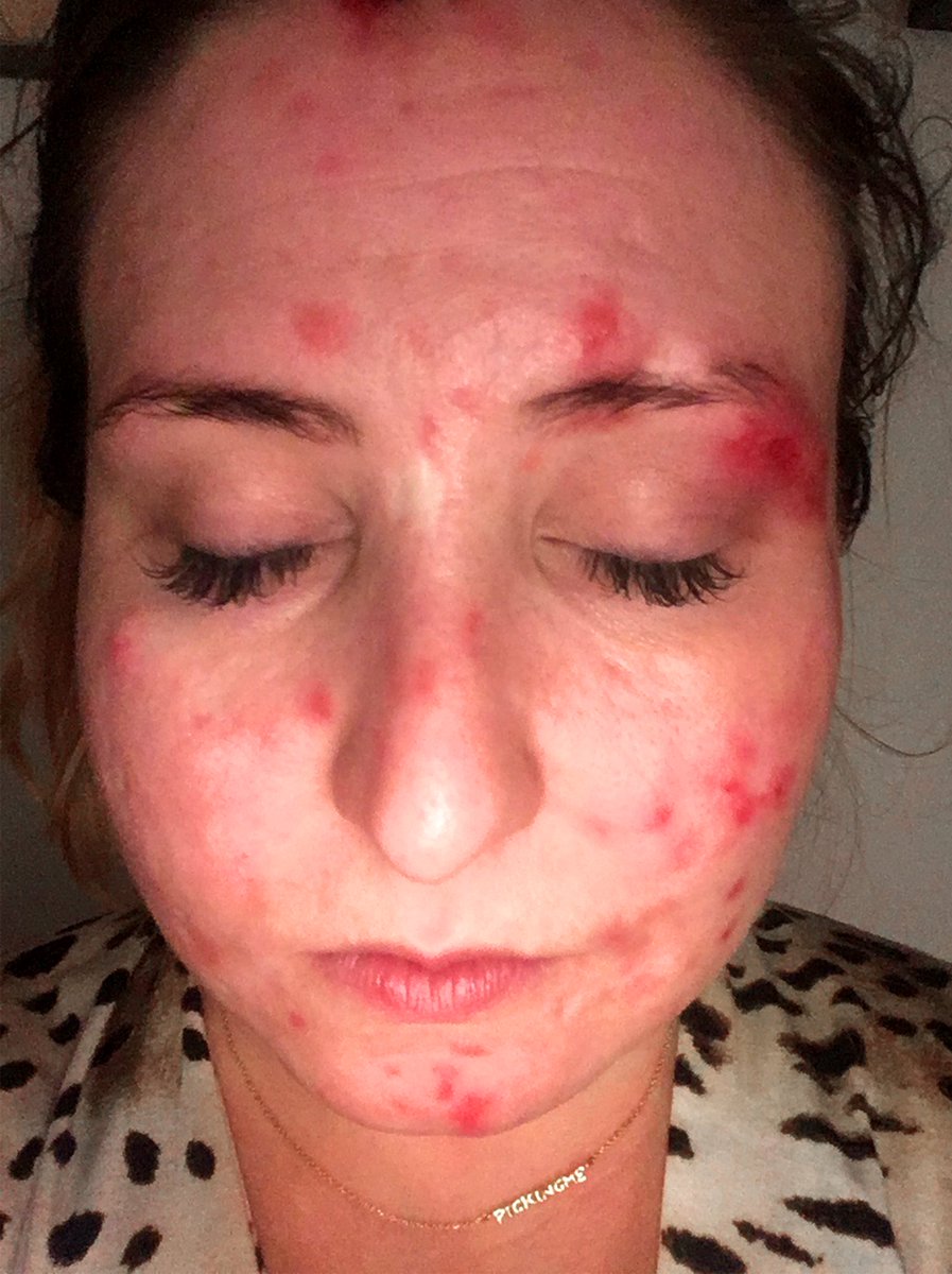 Picking Me Foundation #dermatillomania tweet media