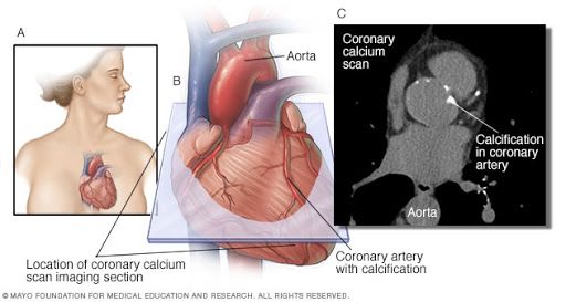 AllMedx's tweet photo. Get current evidence on coronary artery calcium scoring on https://t.co/3dzCcPdSR9
https://t.co/qoGN55d1DD https://t.co/HLPYhbdyYI