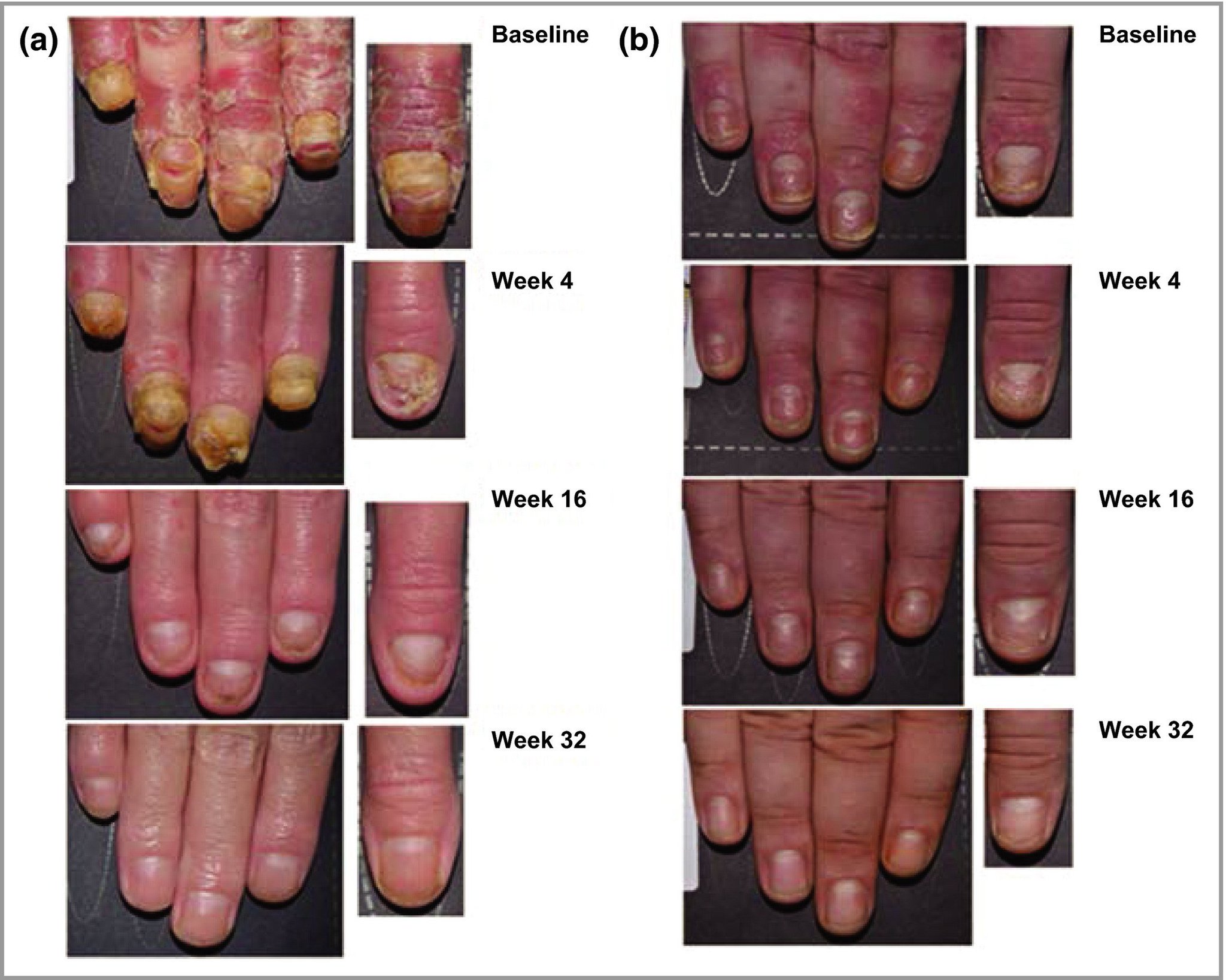 nail psoriasis pictures