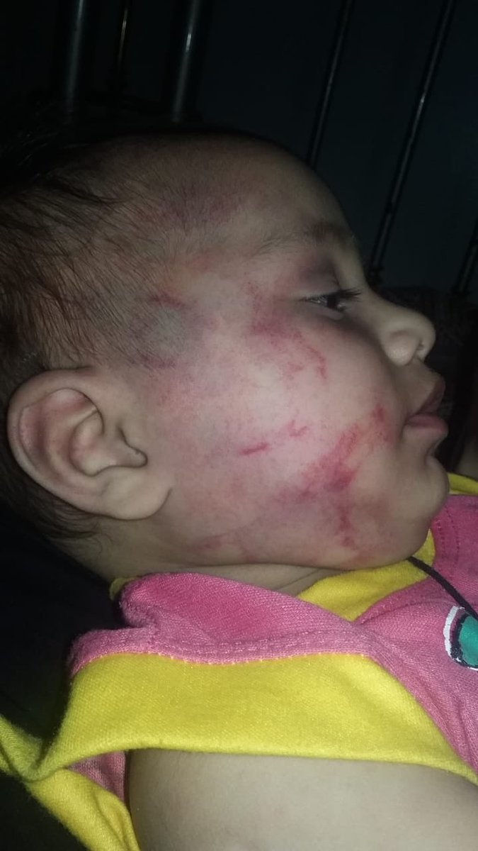 SuhaiAziz's tweet photo. 11 months old Ahmed was rescued by Clifton Police. He had severe torture marks and ruptured eardrum.
He used to get deadly beatings by his step father on daily basis. 
Mother didn't want to register the case. State became the complainant.
Report if u see such atrocities around u. https://t.co/S8xheVznCZ