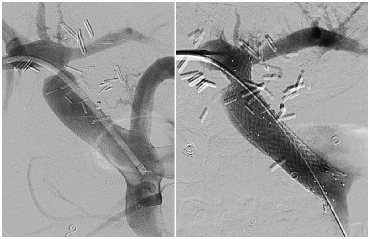 Jeffrey F. B. Chick, MD, MPH (@chickvir) on Twitter photo Liver transplantation with high-grade (>90%) portal vein stenosis, gastroesophageal varices, and splenomegaly with portal vein reconstruction by #IRAD. Portal vein stenting improves symptoms in 81% of patients. Find an #IRAD. #Vo #Vaidya <a href="/UW/">University of Washington</a> <a href="/SIRRFS/">SIR RFS</a> <a href="/EVToday/">Endovascular Today</a> <a href="/JVIRmedia/">JVIR</a> <a href="/SIR_ECS/">SIR ECS</a> Liver transplantation with high-grade (>90%) portal vein stenosis, gastroesophageal varices, and splenomegaly with portal vein reconstruction by #IRAD. Portal vein stenting improves symptoms in 81% of patients. Find an #IRAD. #Vo #Vaidya <a href="/UW/">University of Washington</a> <a href="/SIRRFS/">SIR RFS</a> <a href="/EVToday/">Endovascular Today</a> <a href="/JVIRmedia/">JVIR</a> <a href="/SIR_ECS/">SIR ECS</a>