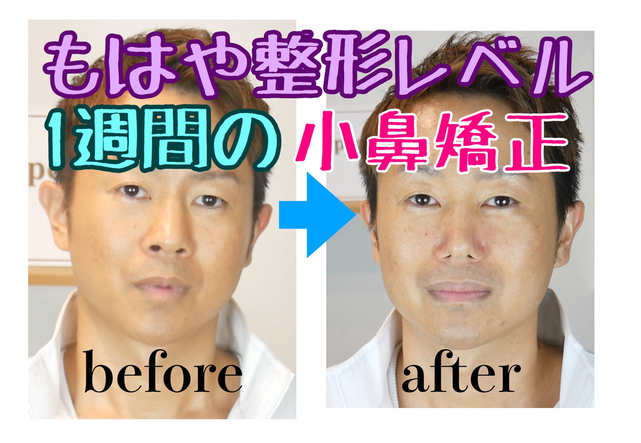 鼻を高くする Twitter Search Twitter