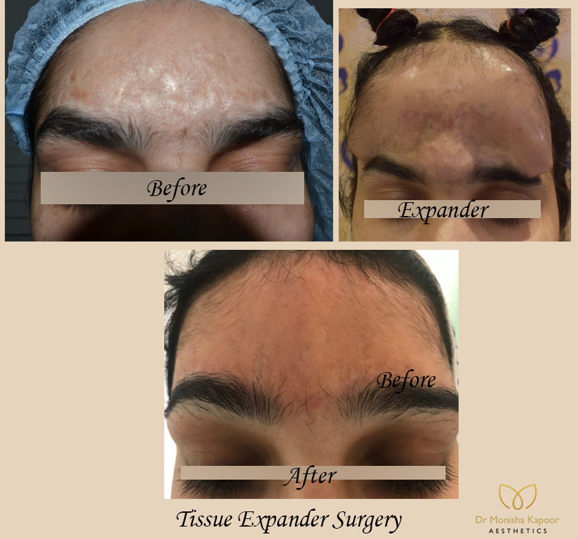 aestheticsdelhi's tweet photo. Tissue Expansion is a procedure performed to promote the growth of healthy supplementary skin used for the replacement of damaged skin.
📞 Call Us - +91 9811439395, 011- 40666307 / 08
📱 WhatsApp - 8860851727
#TissueExpansion #Tissueexpander #Delhi #India #face #drmonishakapoor https://t.co/1GDqhEjVCR