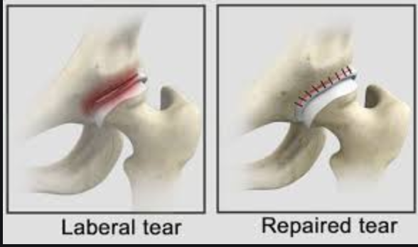 DrJeffPadalecki's tweet photo. Here is how to perform a #HipLabralRepair - https://t.co/GJoT3RxL9W https://t.co/B91YH7quLE